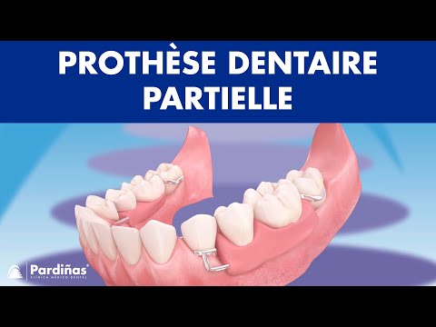 Prothèse dentaire partielle ©