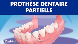Prothèse dentaire partielle ©