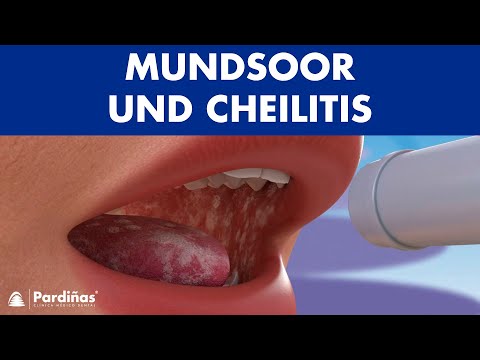 MUNDSOOR - Wie man Candidiasis und andere PILZ IM MUND heilt ©