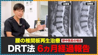 【経過報告】治療後6ヵ月経過報告｜腰痛治療専門医が受けた最新治療「DRT法」