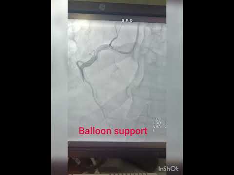 PCI to RCA, use of GUIDELINER.