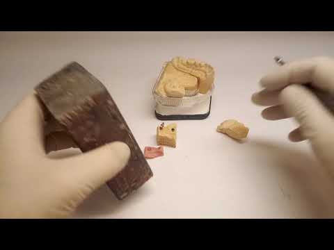 Zahntechnischer Workflow - Bicon: Teil5, Abutmentbearbeitung