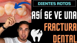 DIENTE ROTO - Así se ve una FRACTURA en una MUELA - FISURA DENTAL
