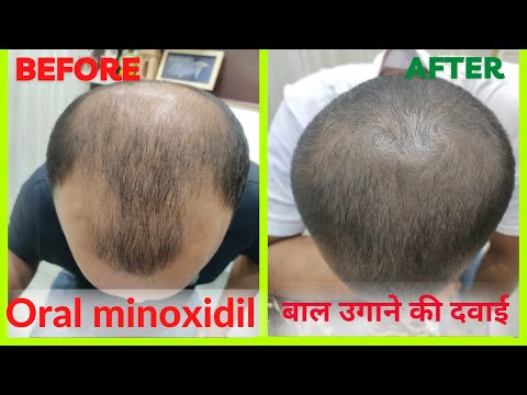 I CANT BELIEVE ORAL MINOXIDIL PROMOTES THIS MUCH HAIR GROWTH  YouTube