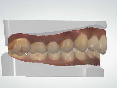Transparent Invisalign Dental Treatment Services
