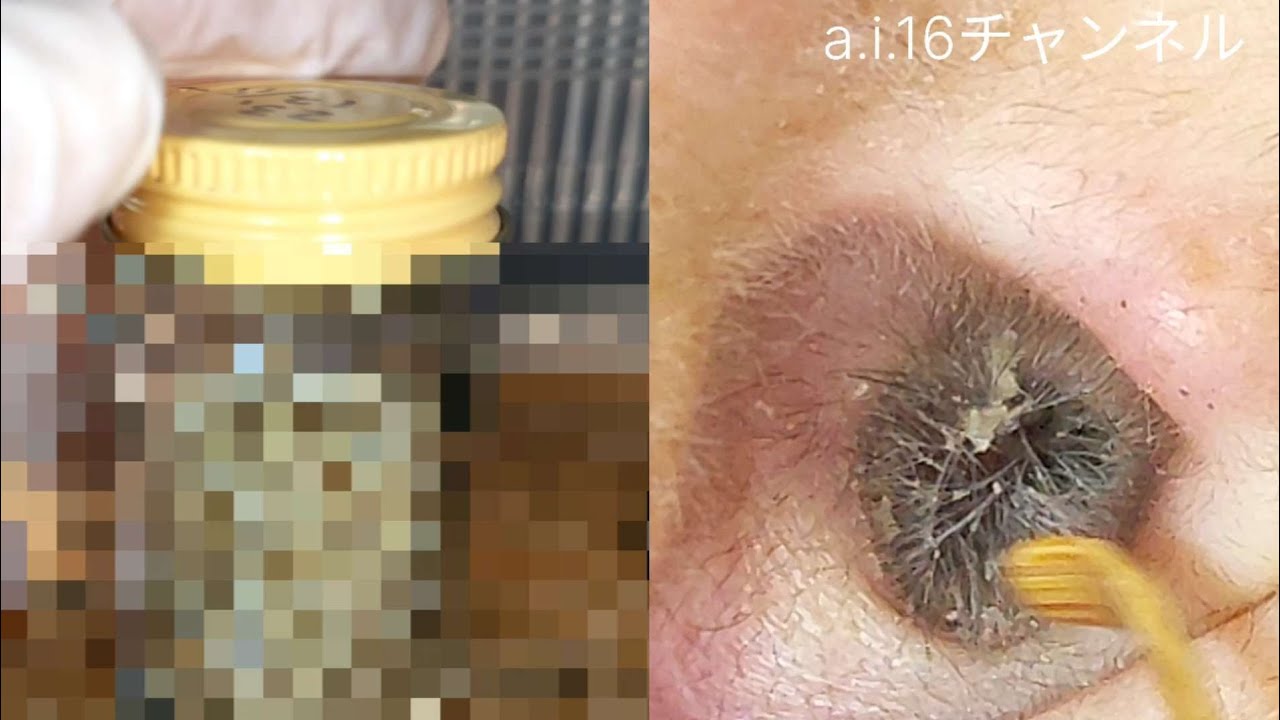 【耳掃除】#158  〜強風で耳主の〇〇が飛ぶw？2年間溜めた耳垢〜  earwax