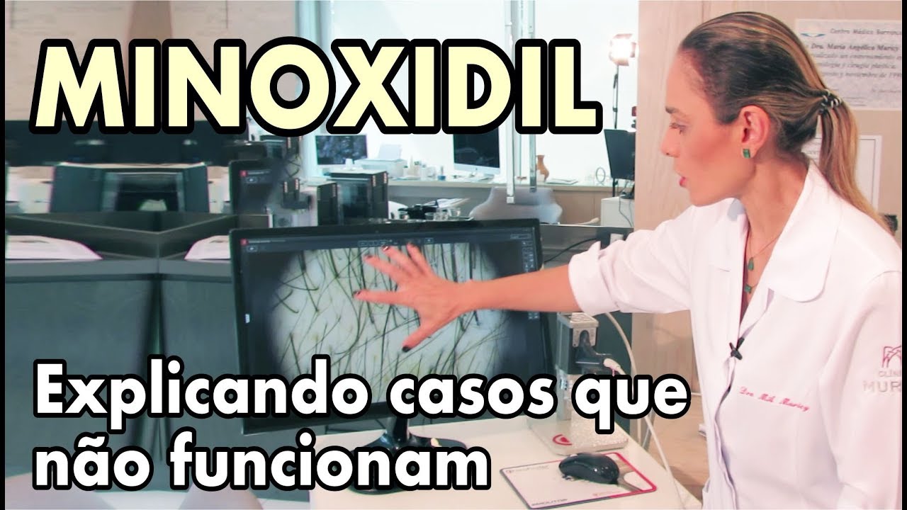 MINOXIDIL - Explicando casos que não funcionam