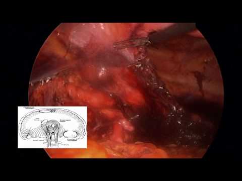 Laparoscopic Congenital Diaphragmatic Hernia Repair In An Adult