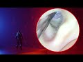 The Truth About Earwax Will Shock You How To Remove Earwax From Ear Earwax Extractions