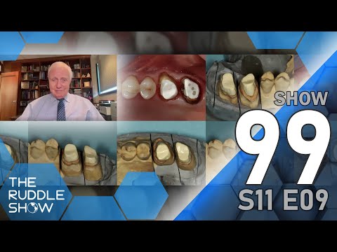 S11 E09 - Restoring Endodontically-Treated Teeth: Special Presentation by Dr. Gordon Christensen