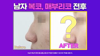 남자 복코 남자 직선코 되고싶어요. 콧볼축소도 필요한가요? #코원성형외과
