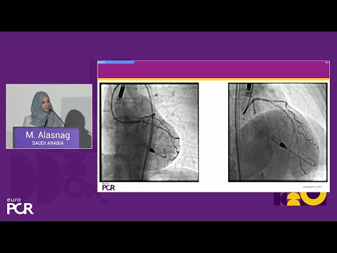Cardiogenic shock and high-risk interventions with percutaneous mechanical circulatory support