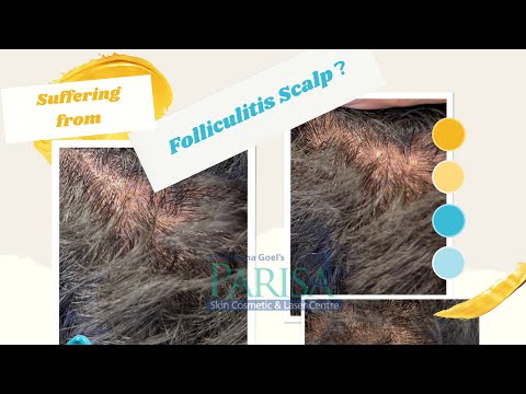 Scalp folliculitis Treatment|Hairfall Treatment |Dr Ashima Goel | Dermatologist Chandigarh #shorts