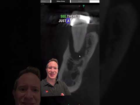 WOULD YOU TREAT THIS TOOTH? PLEASE COMMENT BELOW! 🦷