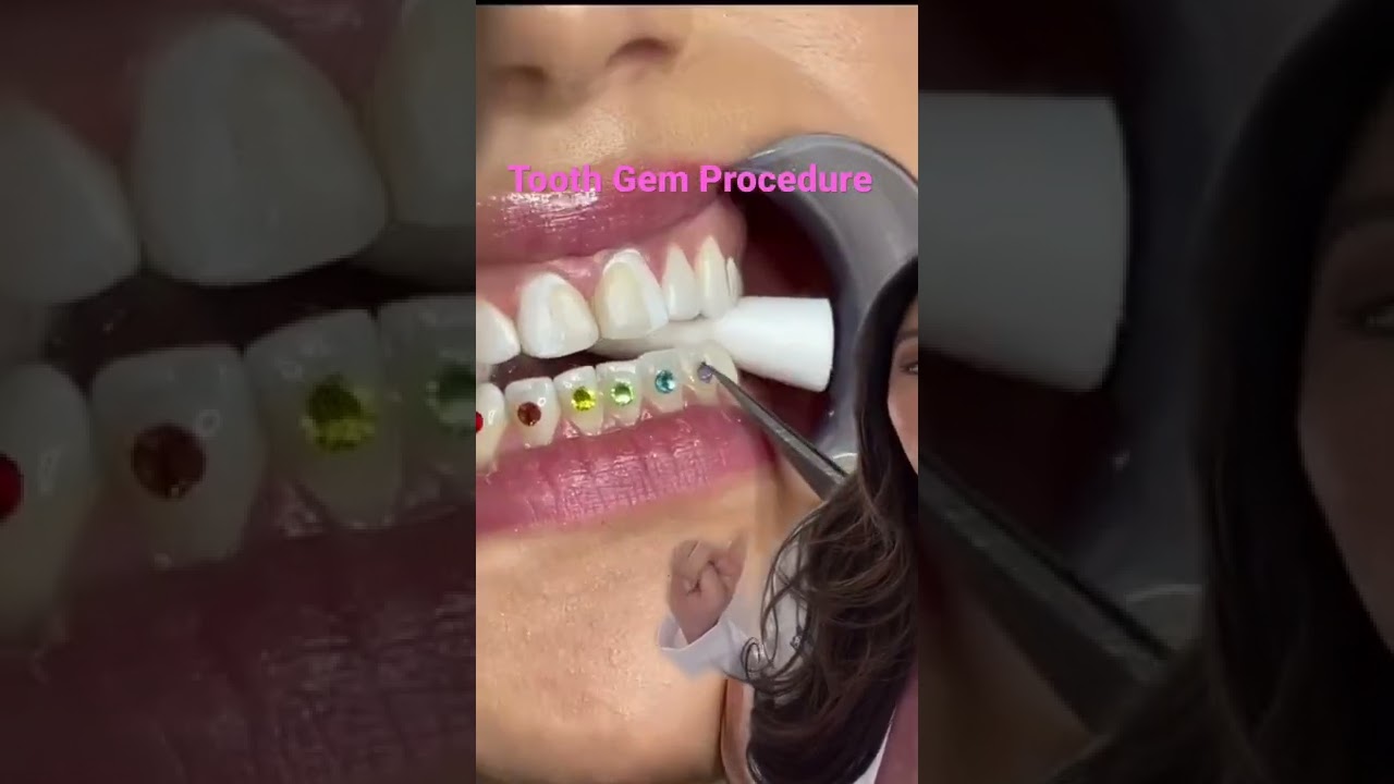 How to Put on Tooth Jewels  / Tooth Gems #shorts #braces #toothgems #cosmetics
