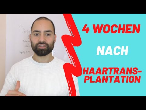 4 Wochen nach Haartransplantation in Istanbul, Vorher Nachher, Meine Erfahrung und Fazit Haarausfall
