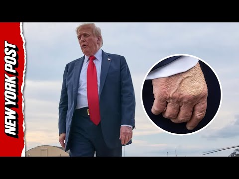 Trump diagnosed with blood circulation issue - as White House addresses his bruised hands