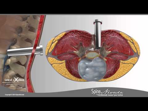 Lumbar Microdiscectomy 