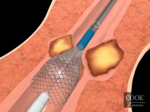 Evolution® Esophageal Controlled-Release Stent – Partially Covered Endoscopic Animation