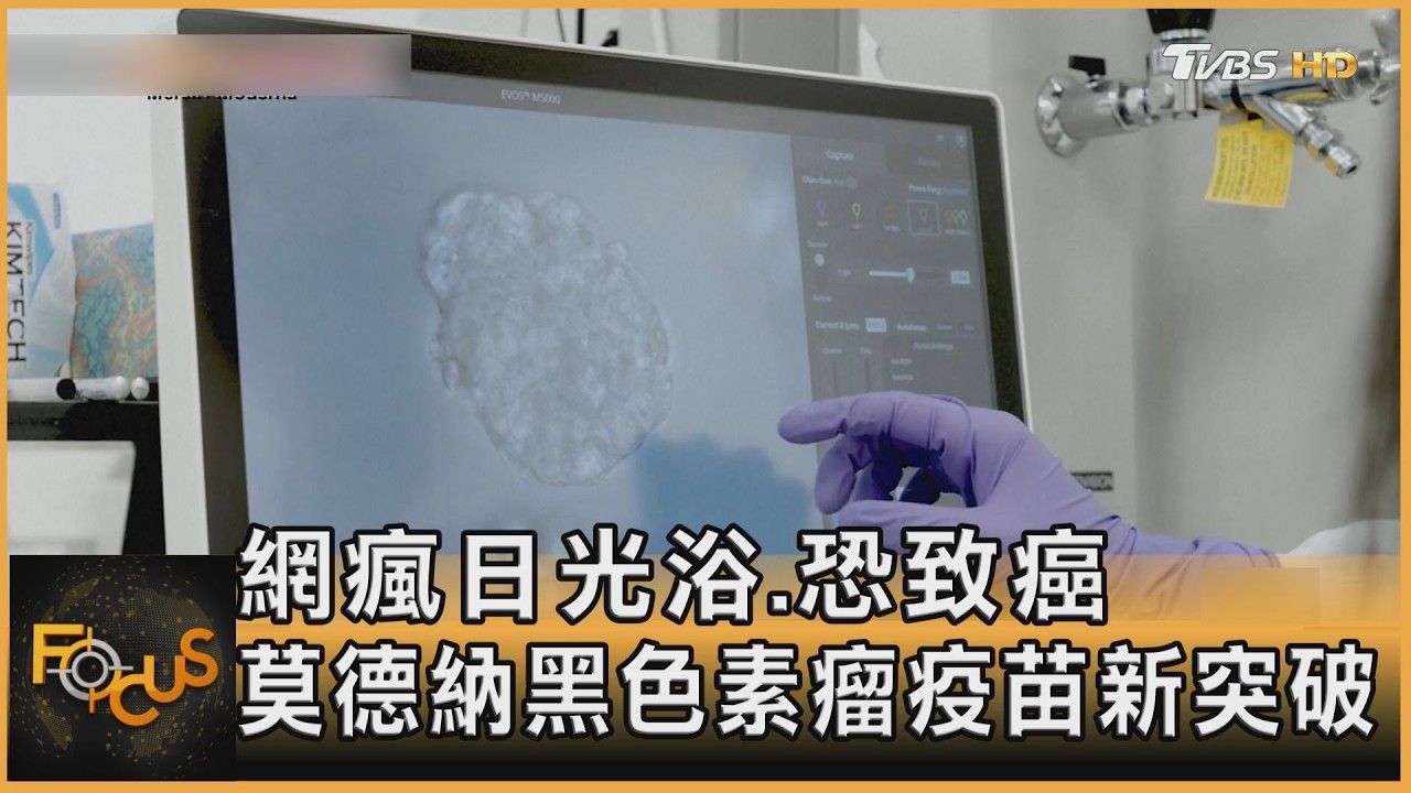 FOCUS全球新聞／ 網瘋日光浴恐致癌　莫德納黑色素瘤疫苗新突破