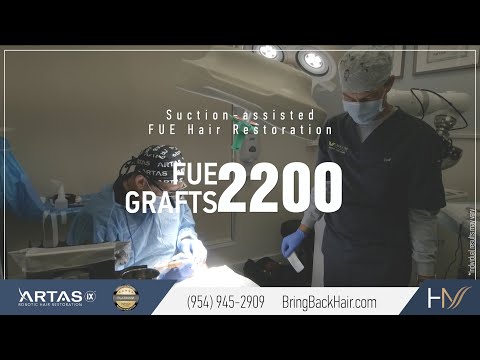 Hair By Dr. Max - 2200 FUE NeoGraft Hair Transplant Procedure, Orlando