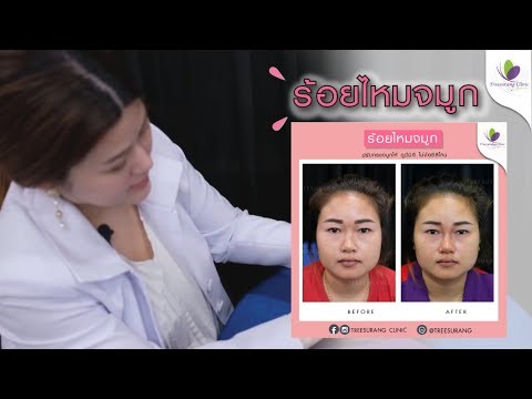 ร้อยไหม คอ ล ลา เจน