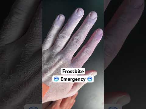 Frostbite? Try this… #medical #health #survival