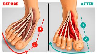 How to Fix Bunions & Flat Feet at The Same Time