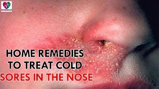 Home Remedies To Treat Cold Sores In The Nose - Health Sutra
