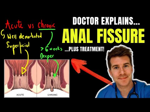 Doctor explains ANAL FISSURE, including causes, classification and treatment options