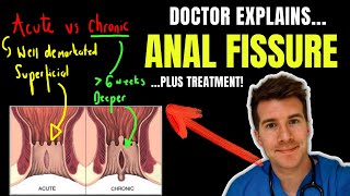 Doctor explains ANAL FISSURE, including causes, classification and treatment options