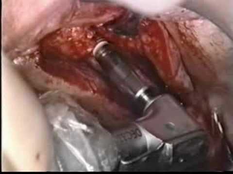 Implants in the Posterior Maxilla (Grafted)