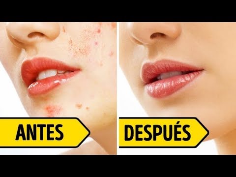 download lagu mp3 mp4 Como Eliminar Las Espinillas Y Manchas De La Cara, download lagu Como Eliminar Las Espinillas Y Manchas De La Cara gratis, unduh video klip Como Eliminar Las Espinillas Y Manchas De La Cara