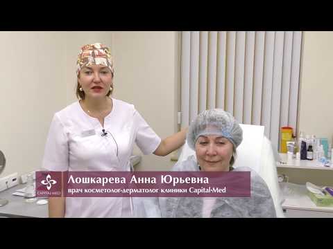Лазерное удаление пигментных пятен.