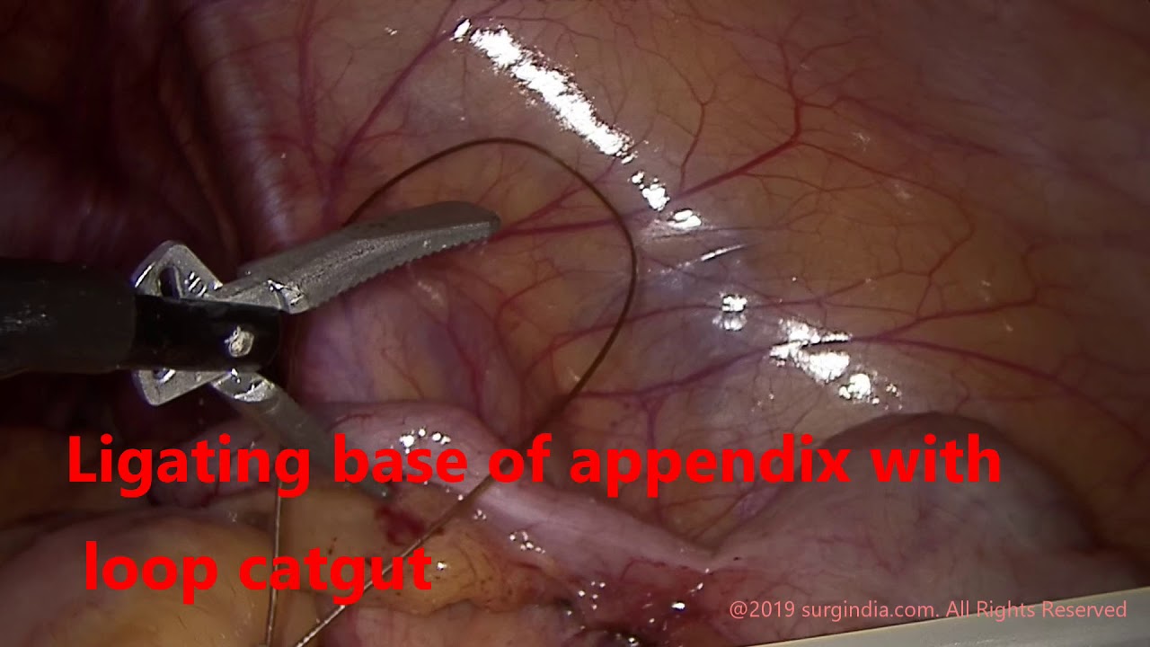 Laparoscopic Appendectomy