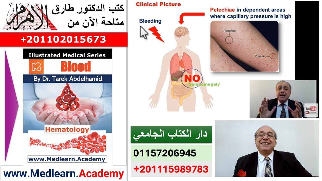 Idiopathic Thrombocytopenic Purpura (ITP) #cme #internal_medicine #medical #usmle #محاضرات_باطنة