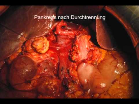 Basal-Insulin in vitro Schwärzt den Fuß bei Diabetikern