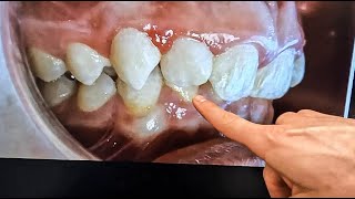 How to FIX your Overbite…complete walkthrough | Orthodontist explains