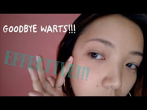 Warts Removal Pen | SKIN UPDATE!