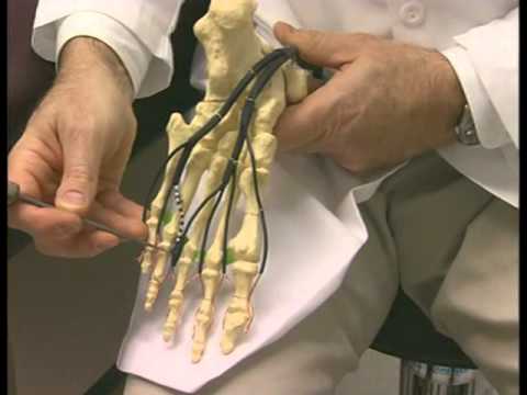 What is Morton's Neuroma?