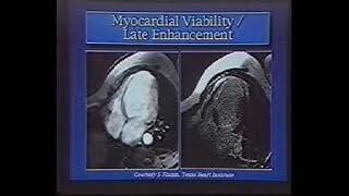 Cardiac MRI