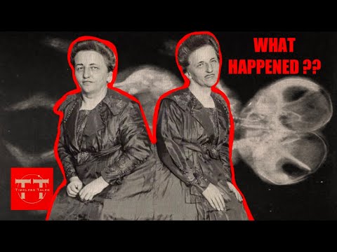The Tragic Life Story of the Conjoined Hilton Sisters