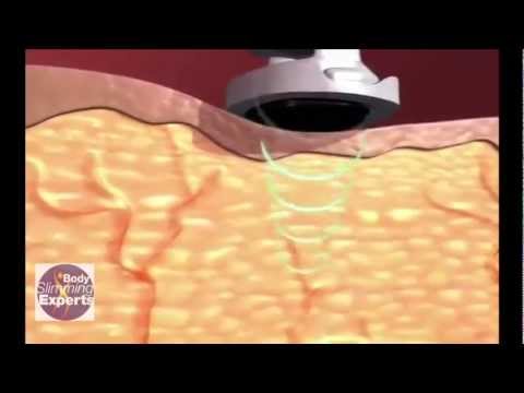 Hydrogen peroxide upang mawala ang timbang sa pamamagitan Neumyvakin Mineral at Timbang Pagkawala