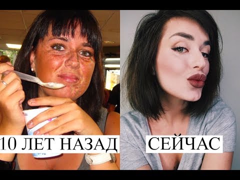 Сильное средство для отбеливания лица Тёмные пятна на лице от прыщей