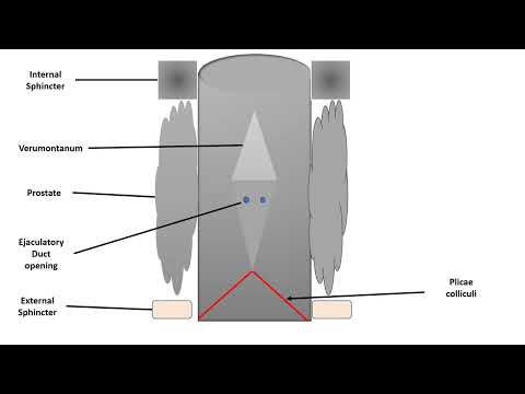 POSTERIOR URETHRAL VALVES