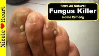 Home Remedy for Toenail Fungus & Athlete's Foot | Natural Fungus Killer by Nicoles Heart