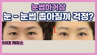 첫 쌍꺼풀 수술, 실패 없이 성공하려면?