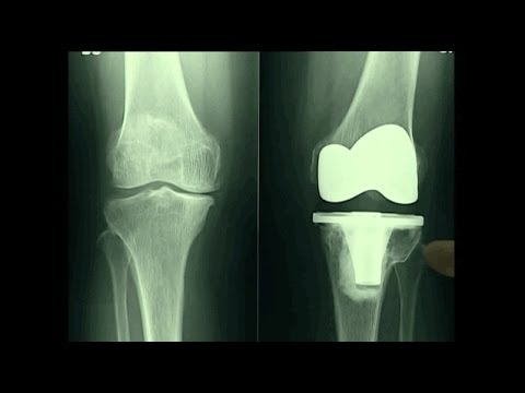 Beni comuni lipo-termine Osteocondrosi cervicale riduce mano