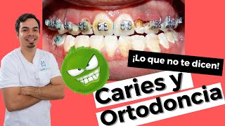 ¡ORTODONCIA Y CARIES! LA ORTODONCIA PUEDE DESTRUIR TUS DIENTES/ CEPILLARSE LOS DIENTES CON BRACKETS.