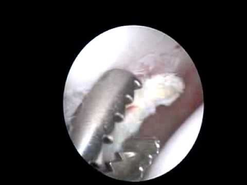 Video come fare radiografie dellarticolazione dellanca Lartrite del ginocchio esercitazioni congiunte